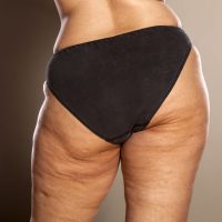 CELLULITE2