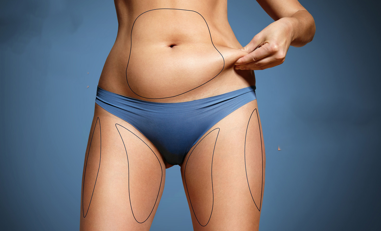 woman pinched her fat on body. Body with marked zones for liposuction